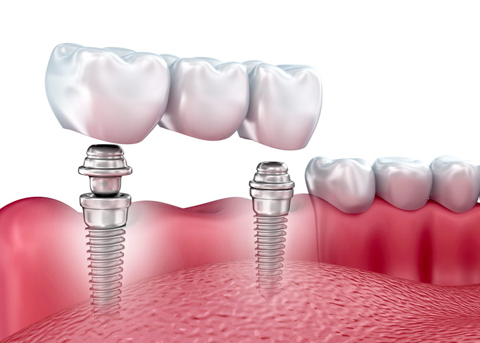 top reasons to consider and implant-supported bridge