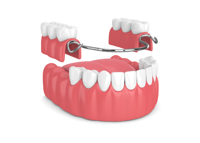 loose-fitting dentures