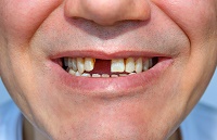 what to consider when addressing a gap in between your teeth